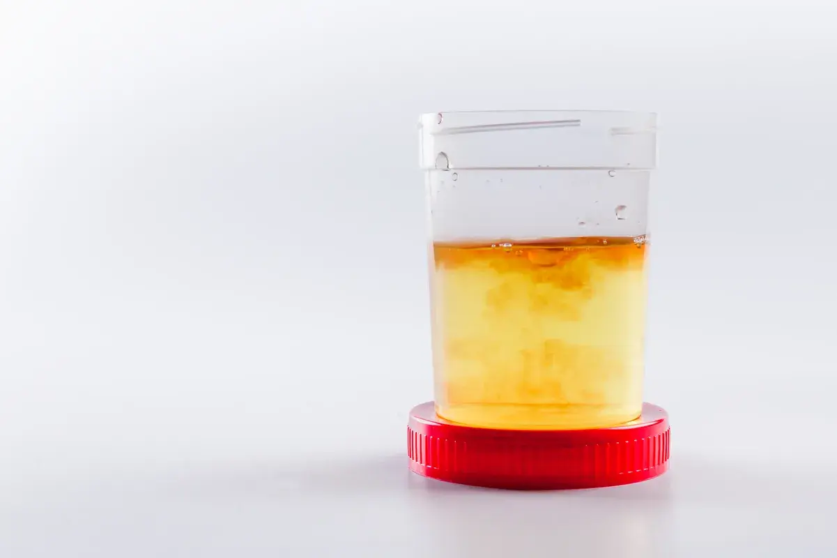 Blood in urine sample